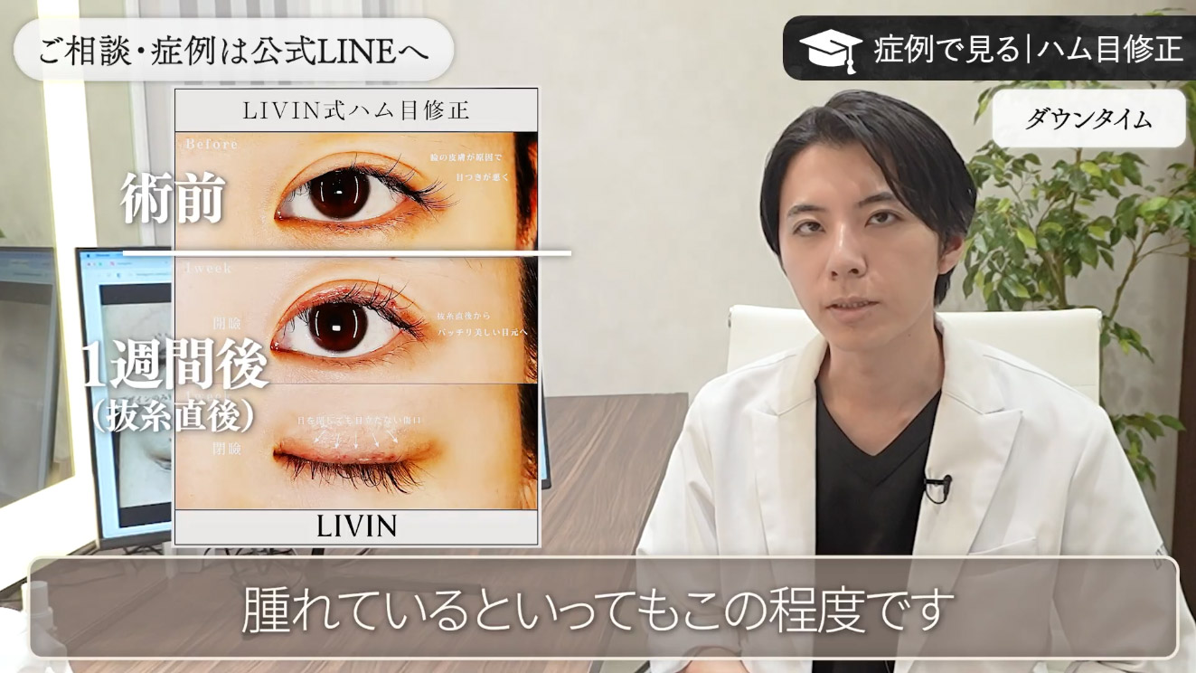 ダウンタイムと腫れの経過