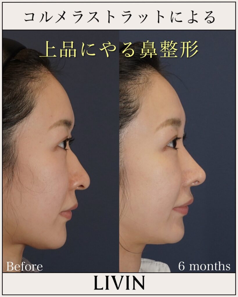 下向きで長い鼻先を上向き・バランスよく整えた鼻整形(ビフォーアフター)