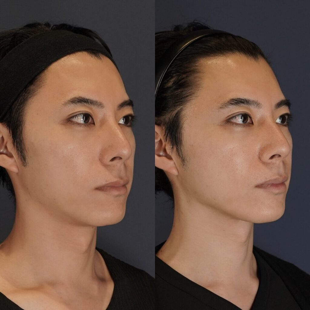 オリジオキス施術前と施術後の症例写真