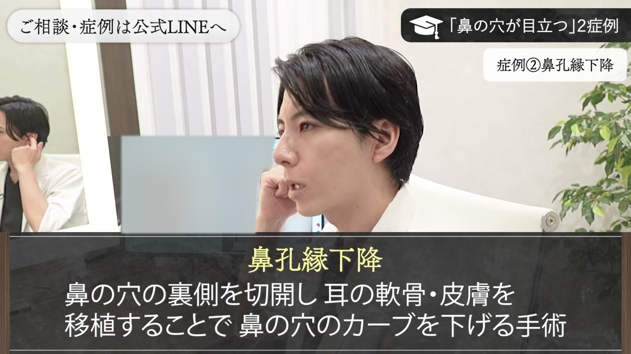 鼻孔縁下降の手術方法を説明する新行内
